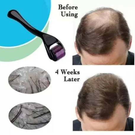 Titanium Micro Needle Derma Roller for Hair, Beard & Skin Care | Acne Scar Removal & Glow Boosting Tool.